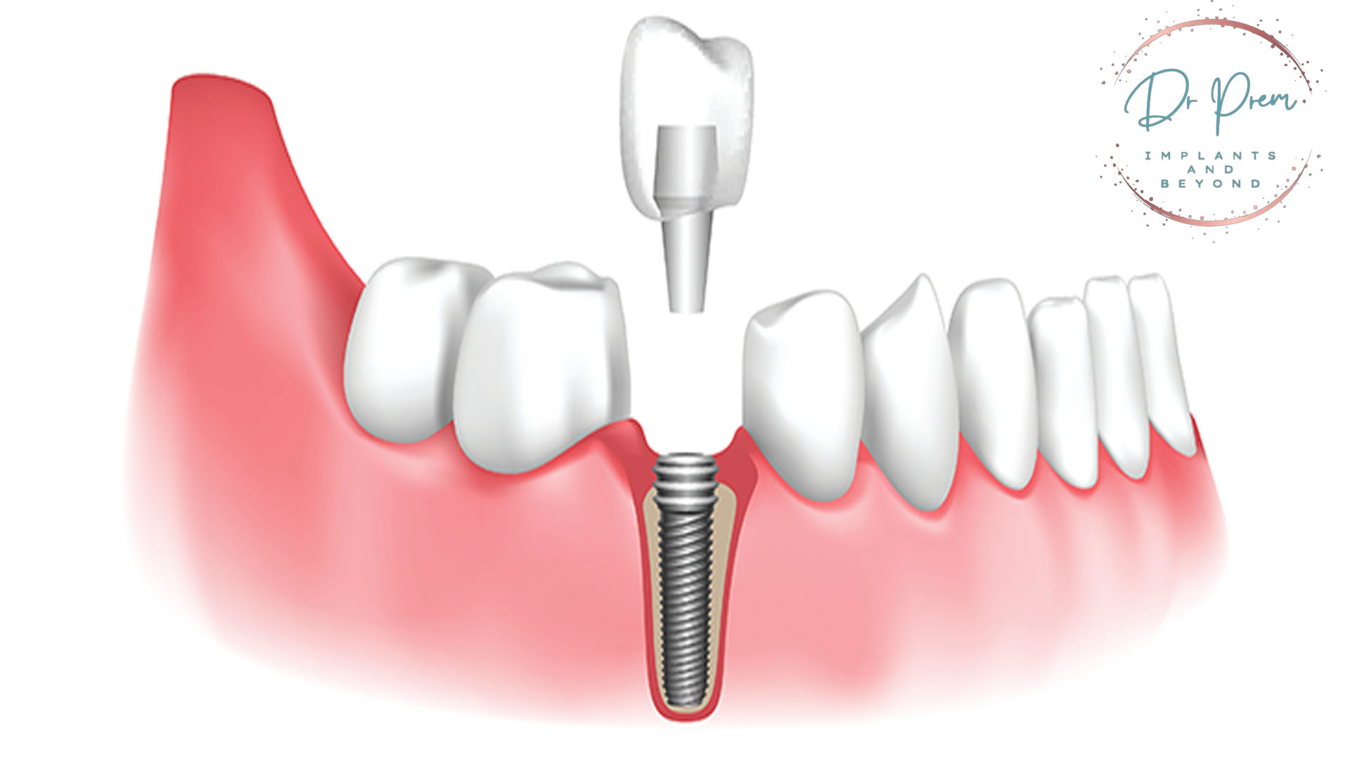 All-on-6 Dental Implants: Six Steps to a Confident and Radiant Smile (DOCTORPREM)