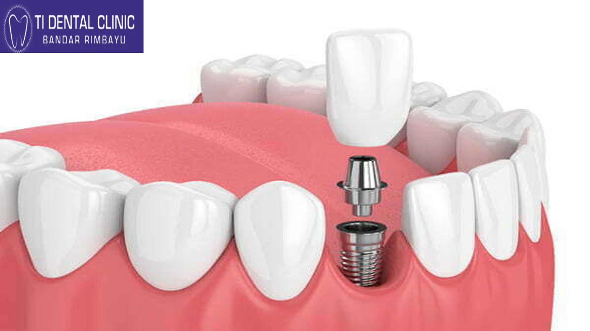 Dental Implants: Success Stories of Renewed Smiles (Tidental)